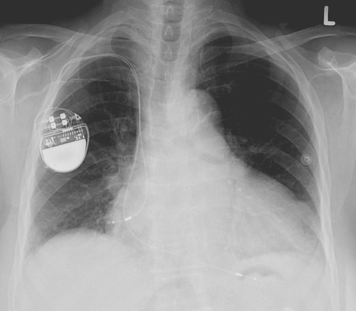 pacemaker xray