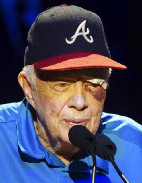 jimmy carter black eye