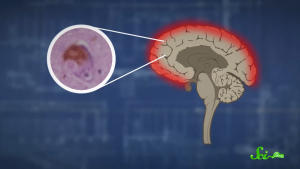 Protein deposits known as Lewy bodies build up along key points of the brain